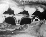 Pollack/Korostoff implant